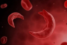 Mengenal Anemia Sel Sabit, Lebih dari Sekadar Kurang Darah