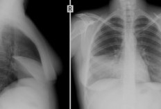 Mengenal Perbedaan Pleuritis dan Pleuritis TB: Dua Gangguan Serupa dengan Penyebab Berbeda