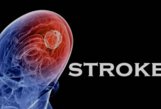 Mengenal Stroke, Penyakit Otak yang Bisa Menyebabkan Kematian Mendadak