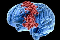 Mengenal Lebih Dekat Penyebab dan Faktor Risiko Tumor Otak