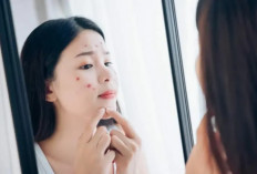 5 Kandungan Skincare yang Harus Dihindari Pemilik Kulit Berjerawat