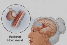 Stroke Hemoragik: Gejala, Pengobatan, dan Cara Pencegahannya