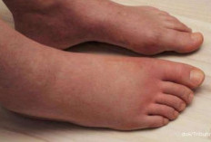 Kaki Bengkak Akibat Diabetes? Kenali Penyebab, Risiko, dan Cara Mengatasinya