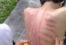 Benarkah Kerokan Bisa Menyebabkan Stroke? Ini Faktanya