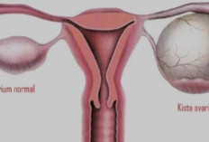 Jangan Terkecoh! Ini Bedanya Kista dan Tumor yang Harus Kamu Tahu