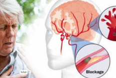 Benarkah Kolesterol Jadi Pemicu Stroke? Ini Fakta Medis yang Perlu Kamu Tahu