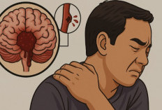 Mengenal Perbedaan Stroke Non Hemoragik dan Hemoragik