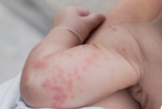 Impetigo pada Anak Jangan Disepelekan, Bisa Berujung Demam Scarlet dan Komplikasi Serius