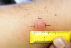 Mengenal Tes Mantoux: Prosedur, Hasil, dan Cara Membaca Reaksinya