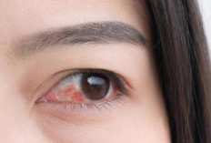Kenapa Mata Bisa Merah Sebelah? Ini Penjelasan Medisnya