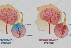Stroke Hemoragik vs Iskemik: Jenis, Risiko, dan Mengapa Pendarahan Otak Lebih Mematikan