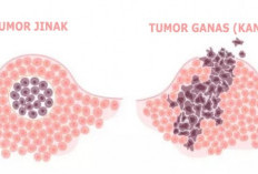 Tumor Jinak atau Ganas? Kenali Ciri, Faktor Risiko, dan Cara Deteksinya!