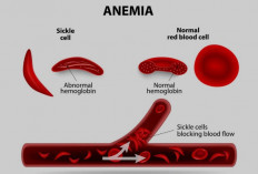 Mengungkap Bahaya Anemia Sel Sabit bagi Kesehatan Tubuh