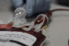 Penyakit Langka Anemia Aplastik dan Tanda-Tandanya