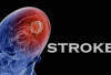 Mengenal Stroke, Penyakit Otak yang Bisa Menyebabkan Kematian Mendadak