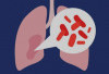 Jauhi Pneumonia Dengan Gaya Hidup Sehat untuk Paru-Paru Kuat