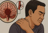 Mengenal Perbedaan Stroke Non Hemoragik dan Hemoragik