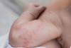 Impetigo pada Anak Jangan Disepelekan, Bisa Berujung Demam Scarlet dan Komplikasi Serius