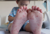 Jangan Anggap Sepele! Ini 5 Cara Lindungi Anak dari Flu Singapura