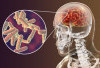 Waspada! Gejala Meningitis Tuberkulosis yang Tak Boleh Diabaikan