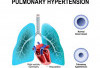 Waspadai Komplikasi Berbahaya Akibat Hipertensi Pulmonal