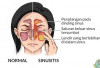 Berbagai Penyebab Sinusitis dan Cara Mencegahnya